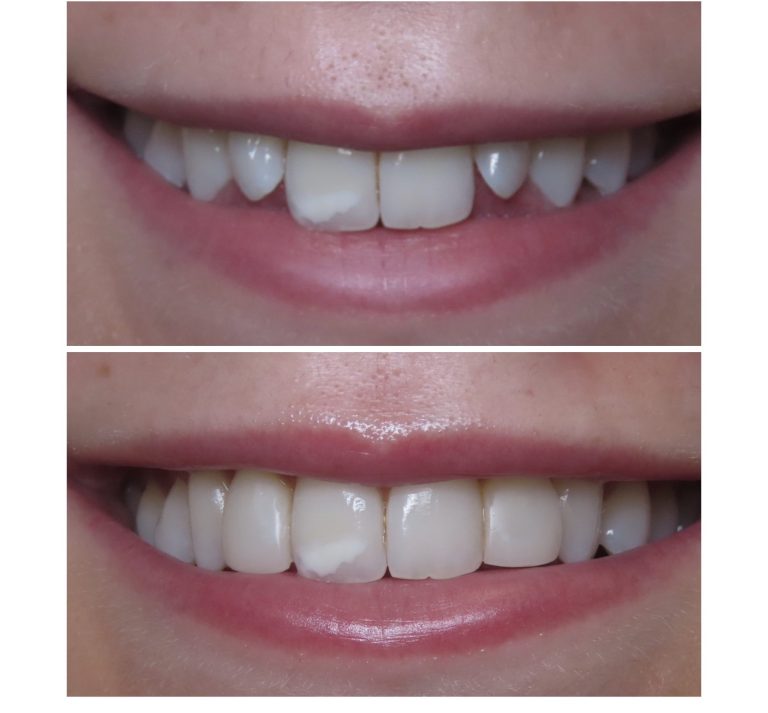 Smile Makeover